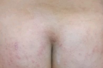 あせもの薬を塗ったおしり